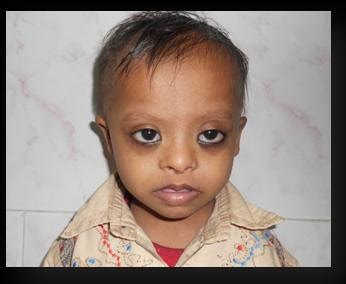 mongoloid vs down syndrome.